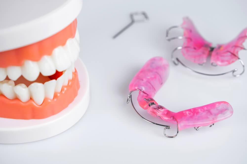 Dental extension device Removable braces for children